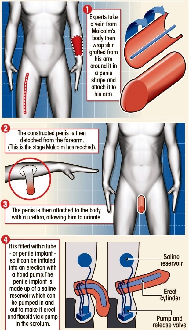 Infografia The Sun reconstruccion pene Infografia The Sun reconstruccion pene