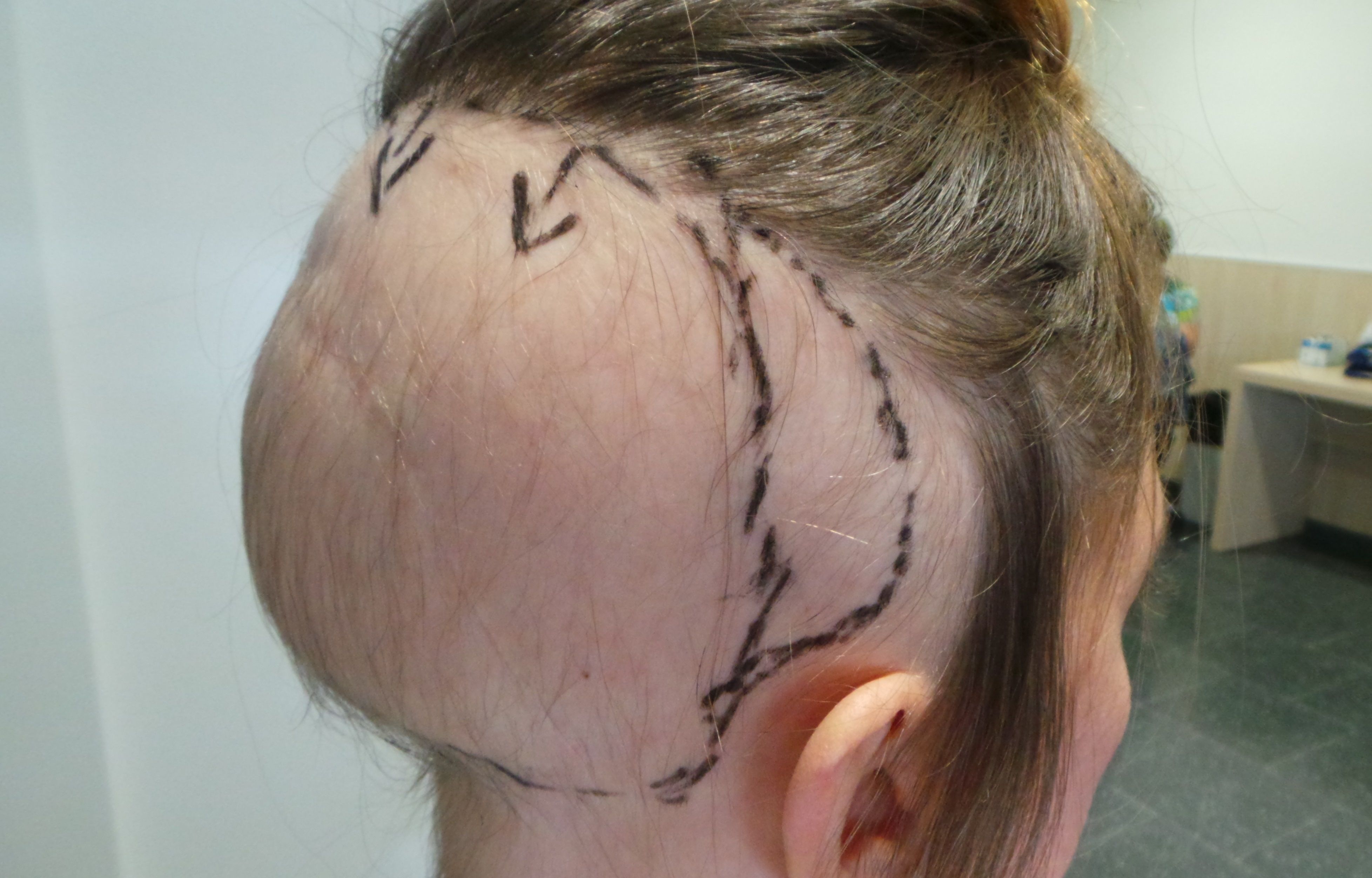 EuropaPress 1763112 tratamiento precoz alopecia estabiliza perdida cabello nueve cada diez