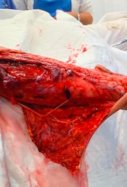 brazo encierro sanfermines