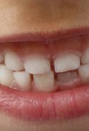 Dents nens - Josef Pichler