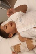 Niño ojo quemado gel hidroalcohólico / Foto: Cedida por la familia a La Voz de Galicia