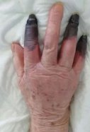 Secuela Covid / European Journal of Vascular and Endovascular Surgery