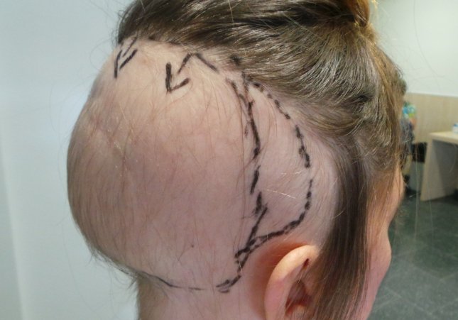 EuropaPress 1763112 tratamiento precoz alopecia estabiliza perdida cabello nueve cada diez