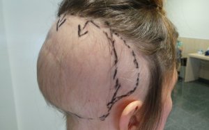 EuropaPress 1763112 tratamiento precoz alopecia estabiliza perdida cabello nueve cada diez