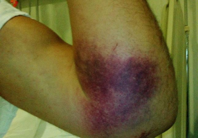 brazo brazo