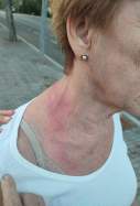 lesions (1)