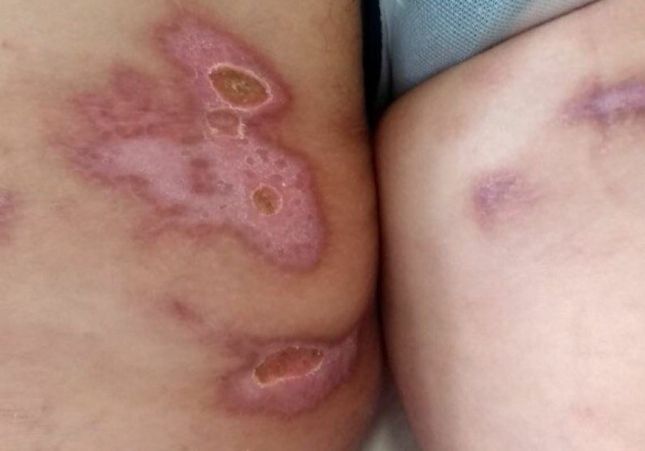 heridas ácido heridas ácido