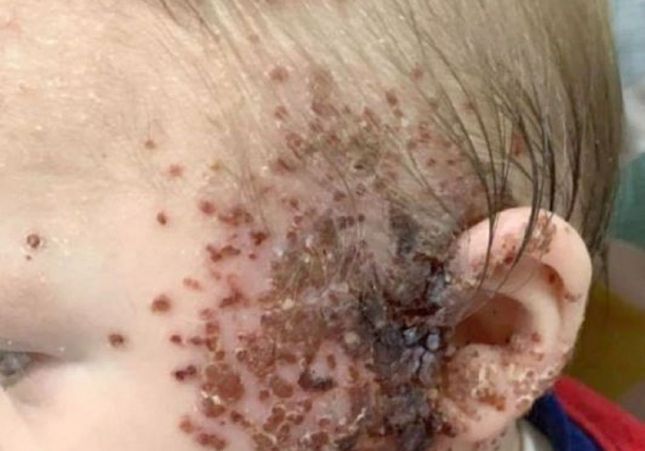 Bebé cono herpes Bebé cono herpes